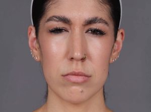 Botox Cosmetic After