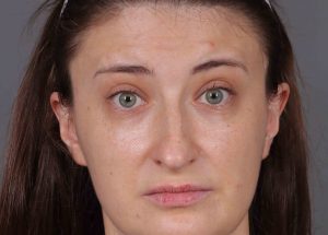 Botox Cosmetic After