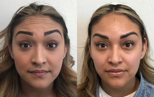 Botox (10)