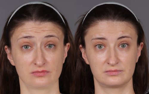 Botox (11)