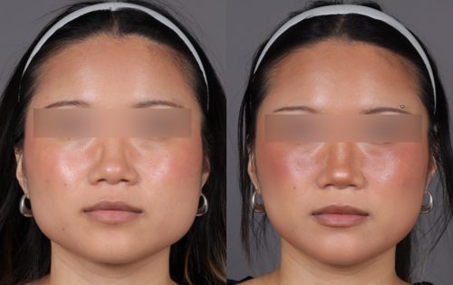 Botox (13)