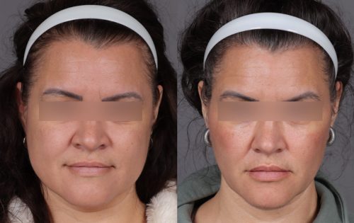 Botox (15)