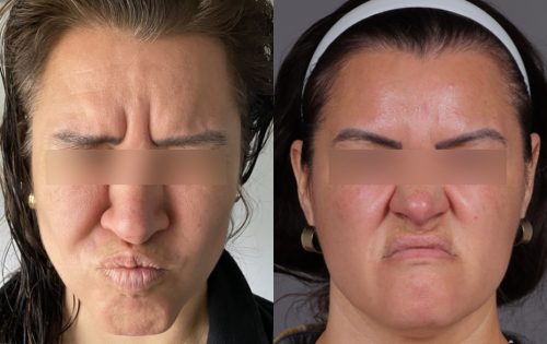 Botox (16)