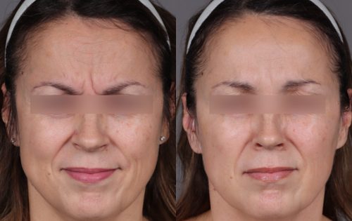 Botox (18)