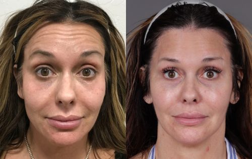 Botox (2)