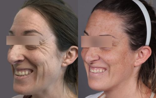 Botox (20)