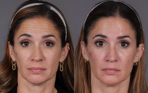 Botox (3)
