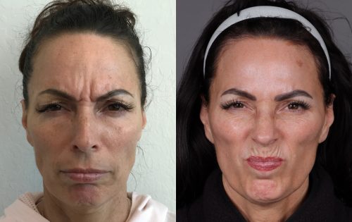 Botox (5)
