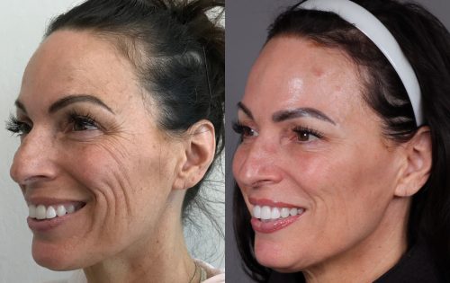 Botox (6)