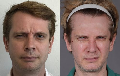 Botox (7)