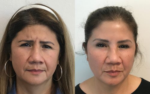 Botox (9)