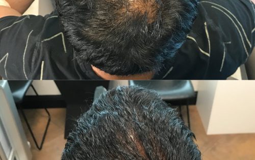 PRP for hair- before and after