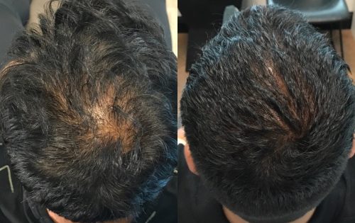 PRP for hair- before and after