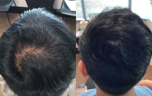 PRP for hair- before and after