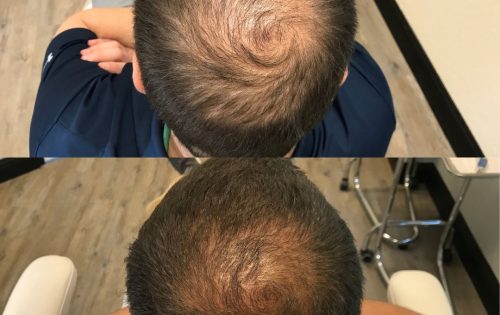 PRP for hair- before and after