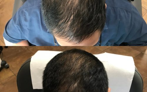 PRP for hair- before and after