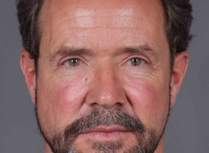 Botox Cosmetic After